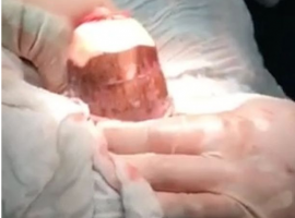Surgeons had to carefully remove the yuca to avoid causing additional damage. (Screen capture)